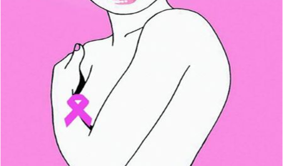 乳腺癌