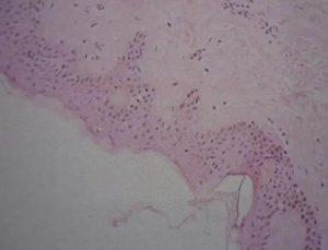纤维瘤的病因-检查-诊断-治疗