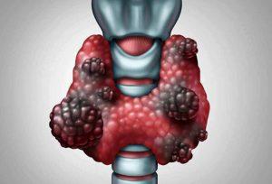 甲状腺癌的类型、分期、症状、诊断、治疗及预期寿命
