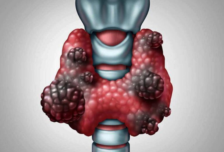 甲状腺癌的类型、分期、症状、诊断、治疗及预期寿命