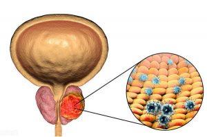 前列腺癌
