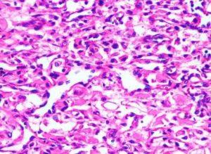 母细胞瘤病因-症状-能活多久