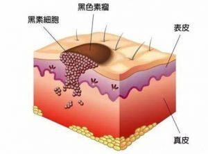 黑色素瘤