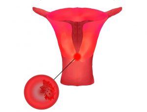 子宫颈癌的早期症状和诊断治疗，以及筛查和预防