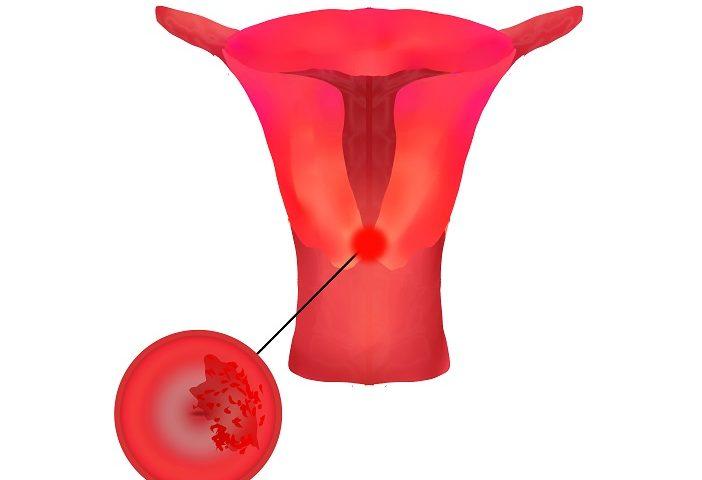 子宫颈癌的早期症状和诊断治疗,以及筛查和预防