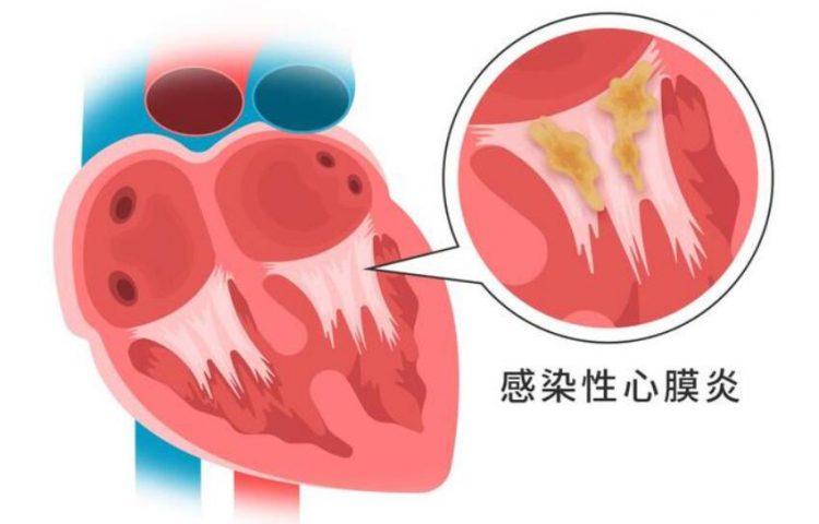 感染性心内膜炎