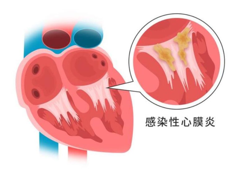 感染性心内膜炎