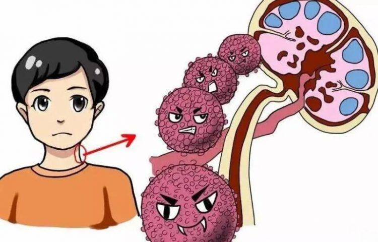 淋巴瘤