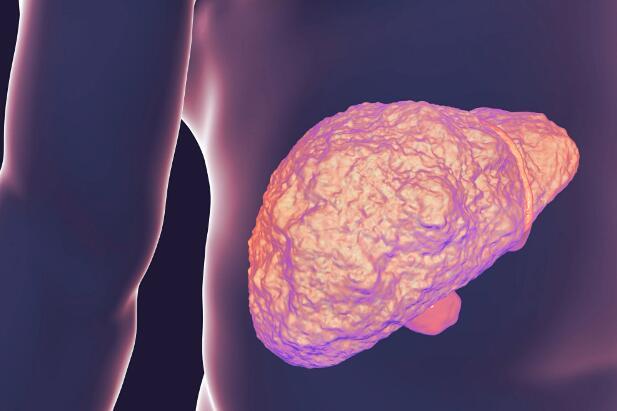 非酒精性脂肪性肝炎