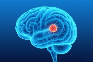 儿童低级别胶质瘤