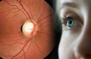 拉坦前列素制剂Iyuzeh用于青光眼患者