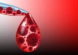 Waldenström巨球蛋白血症