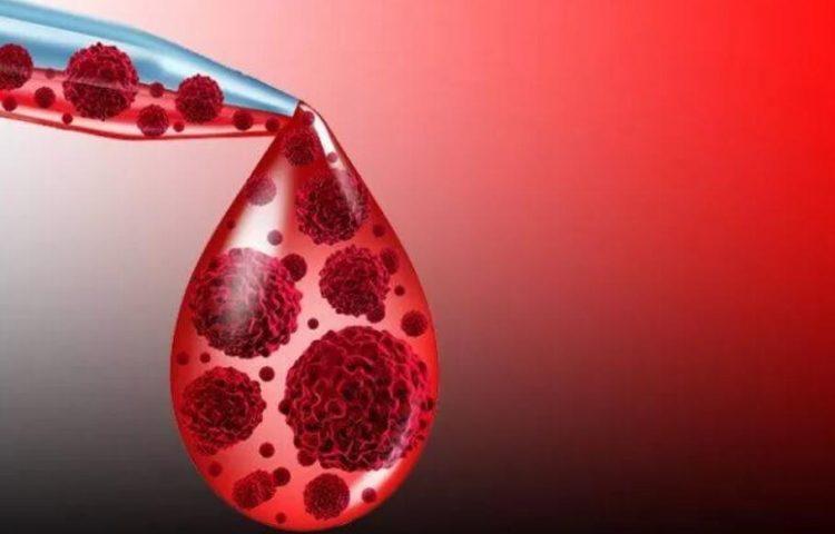 Waldenström巨球蛋白血症