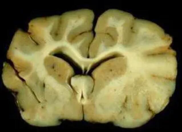 异染性脑白质营养不良