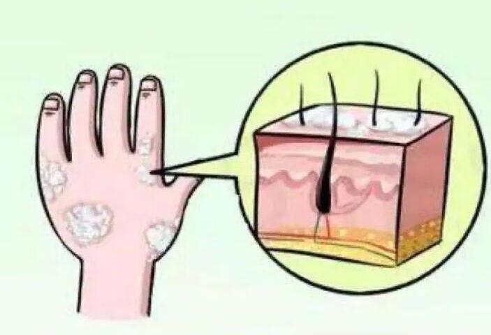 牛皮癣性关节炎