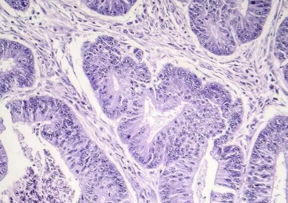 食道鳞状细胞癌