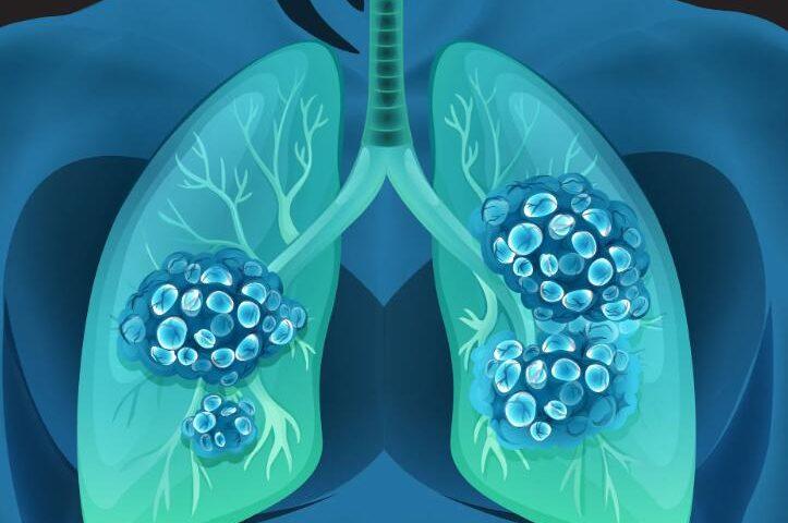 非小细胞肺癌