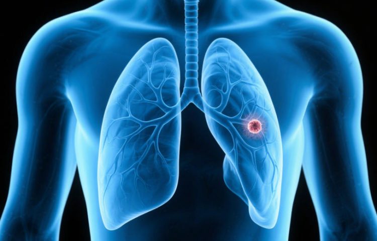 非小细胞肺癌