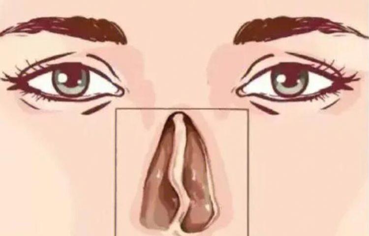 鼻中隔偏曲
