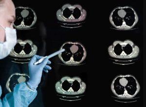 研究显示CT筛查大大提高了肺癌的生存率