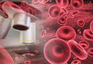 Casgevy治疗β地中海贫血