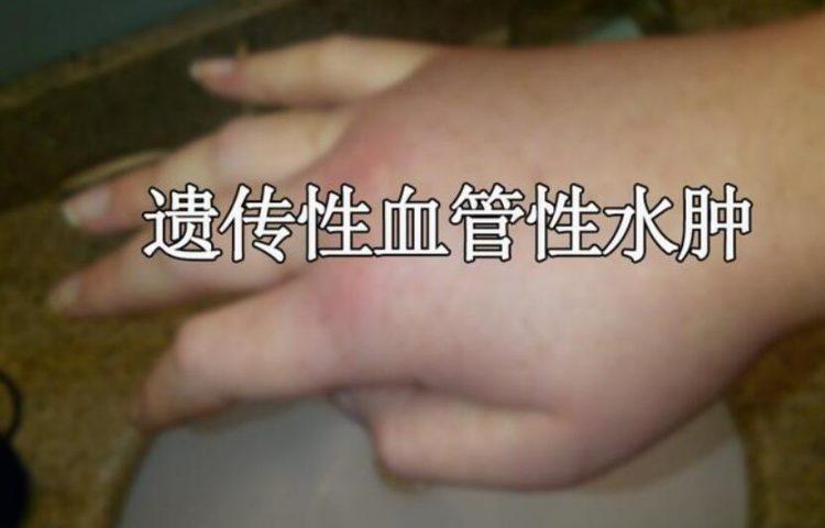 遗传性血管性水肿