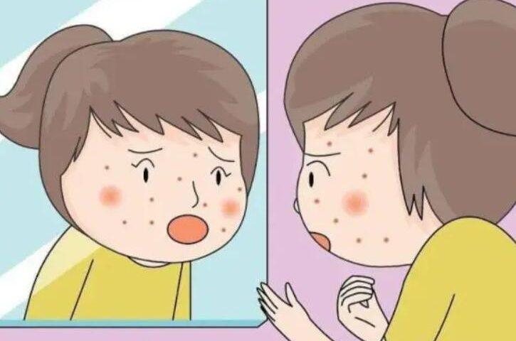 寻常痤疮
