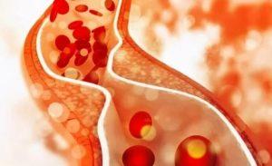 经典半乳糖血症