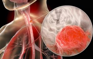 食管鳞状细胞癌