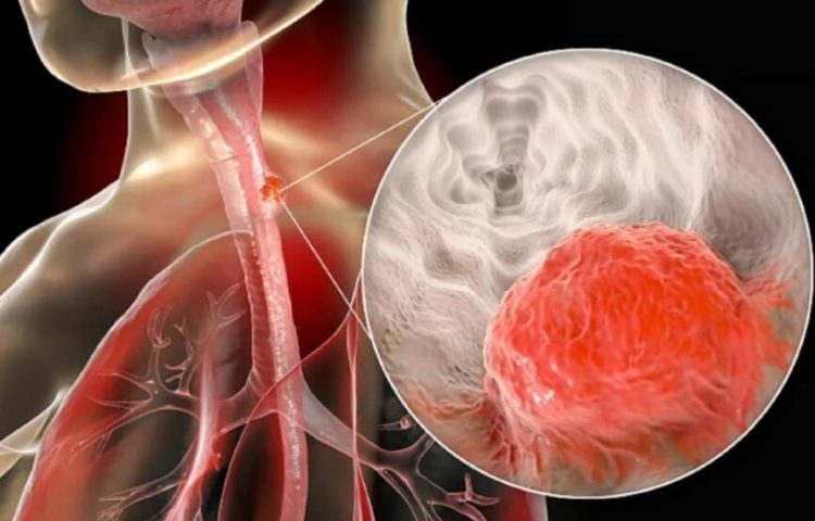 食管鳞状细胞癌