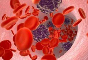 Orca-T在晚期血液系统恶性肿瘤中被证明是安全有效的