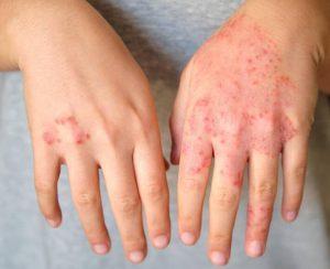 手部湿疹(特应性皮炎)