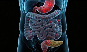 胃肠胰神经内分泌肿瘤