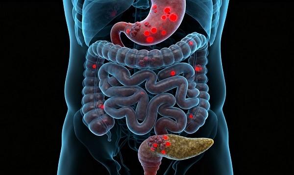 胃肠胰神经内分泌肿瘤