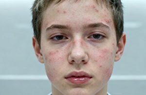 Wiskott-Aldrich综合征